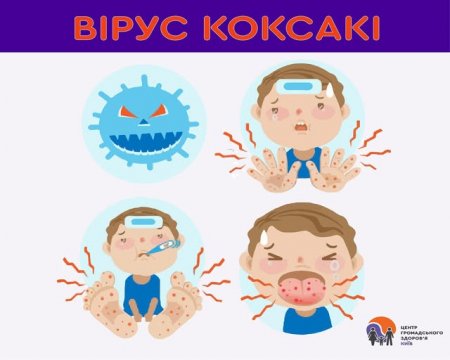 Вірус Коксакі: симптоми і профілактика Вірус Коксакі: симптоми і профілактика